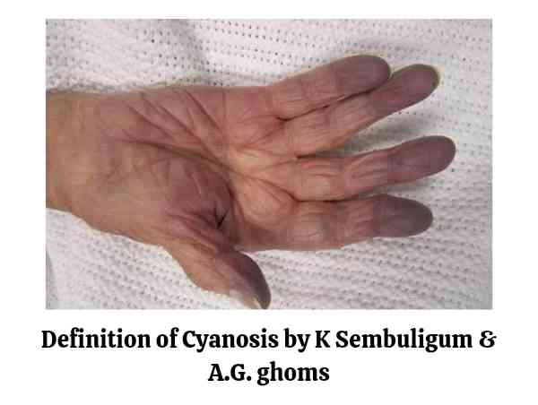 What is Cyanosis? Definition by A.G. ghoms & Sembulingum