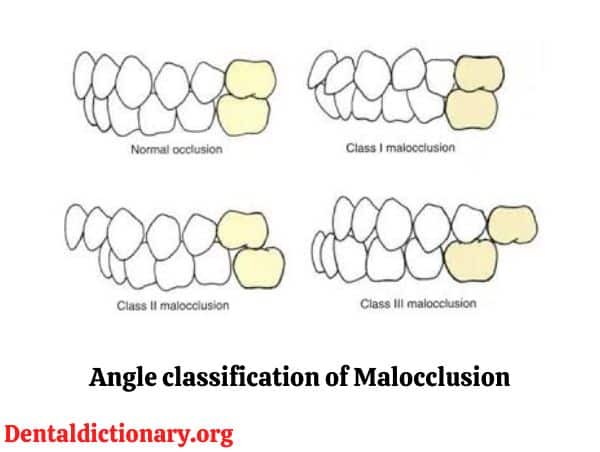 Angle classification of malocclusion