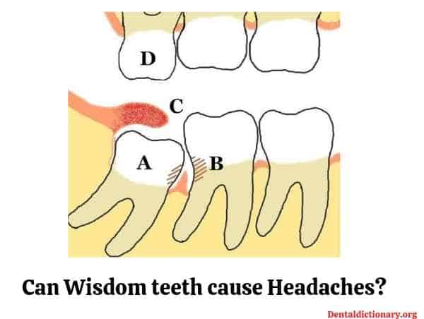 can wisdom teeth cause Headaches?