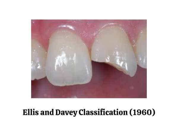 Ellis and Davey Classification of tooth fracture (1960)