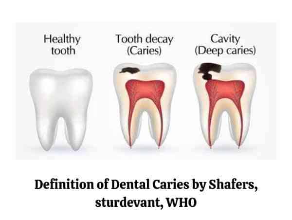 dental caries definition by shafers