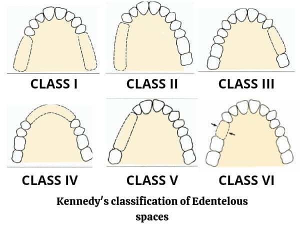 Kennedy's classification of rpd
