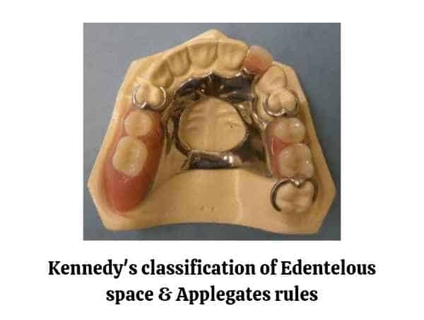 Kennedy’s classification of Edentulous arch & Applegates rules
