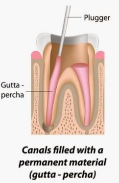 obturation of root canal