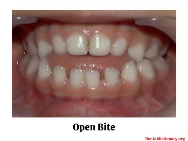 Open Bite – Definition, Diagnosis & Treatment