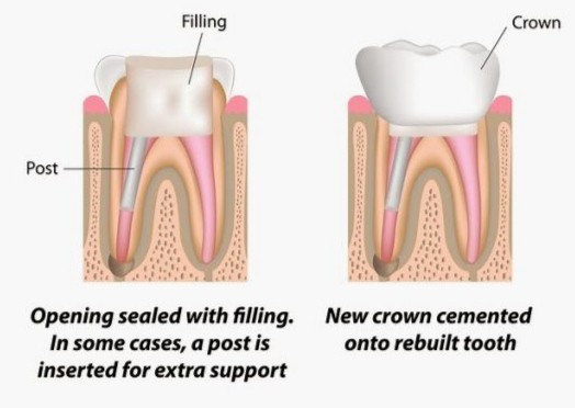 post obturation and crown placement procedure
