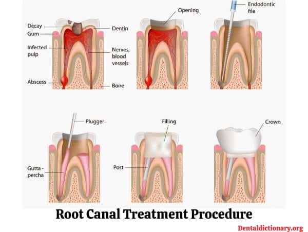 Root Canal treatment – step by step procedure