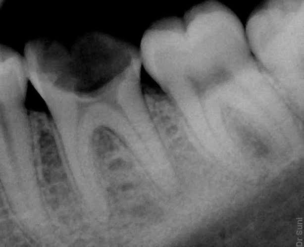 what does a cavity look like on xray