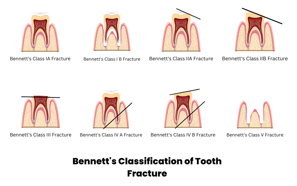 Bennett's classification of tooth fracture