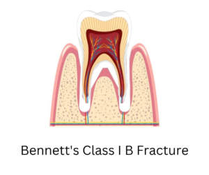 Bennett's class 1 B fracture