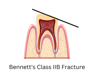 Bennett's class 2 B fracture