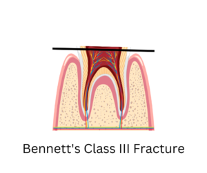Bennett's class 3 fracture