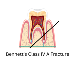 Bennett's class 4 A fracture