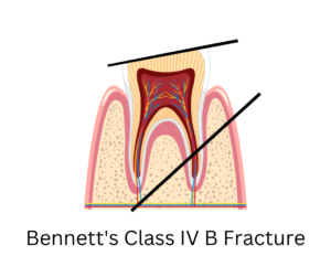 Bennett's class 4 B fracture