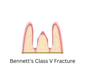 Bennett's class 5 fracture