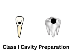 Class I Cavity Preparation