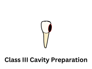 Class III Cavity Preparation