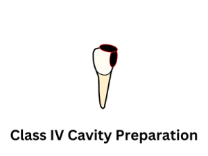Class IV Cavity Preparation