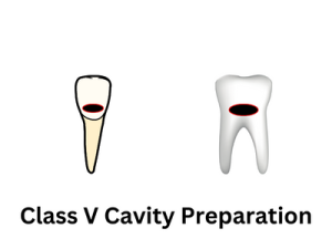 Class V Cavity Preparation